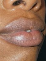 Avant diminution des lèvres