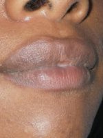 Après diminution des lèvres