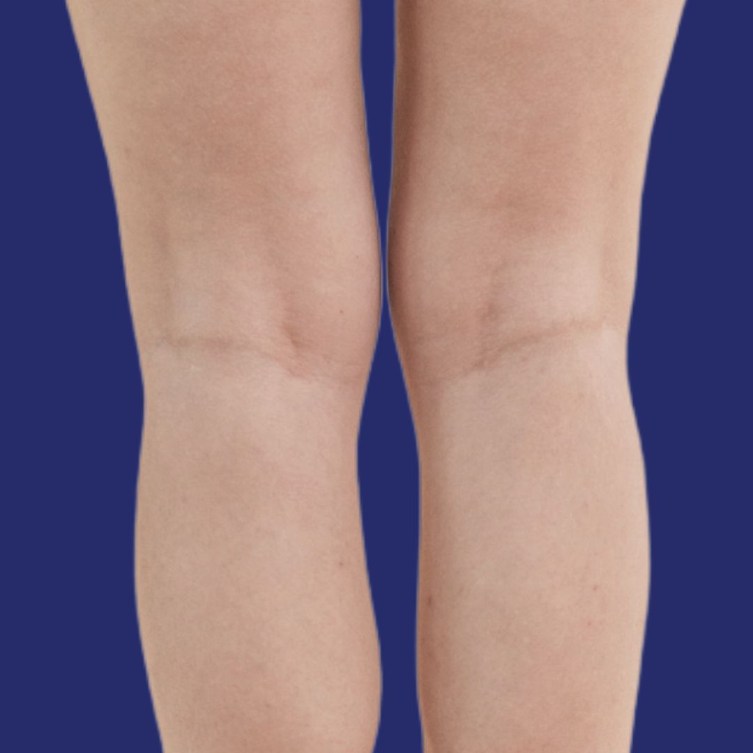 Résultat de jambes plus lisses sans veines visibles après traitement vasculaire
