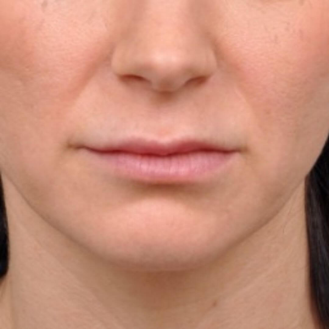 Gros plan des lèvres avant la chirurgie de lip lift, montrant une définition subtile de la lèvre supérieure.