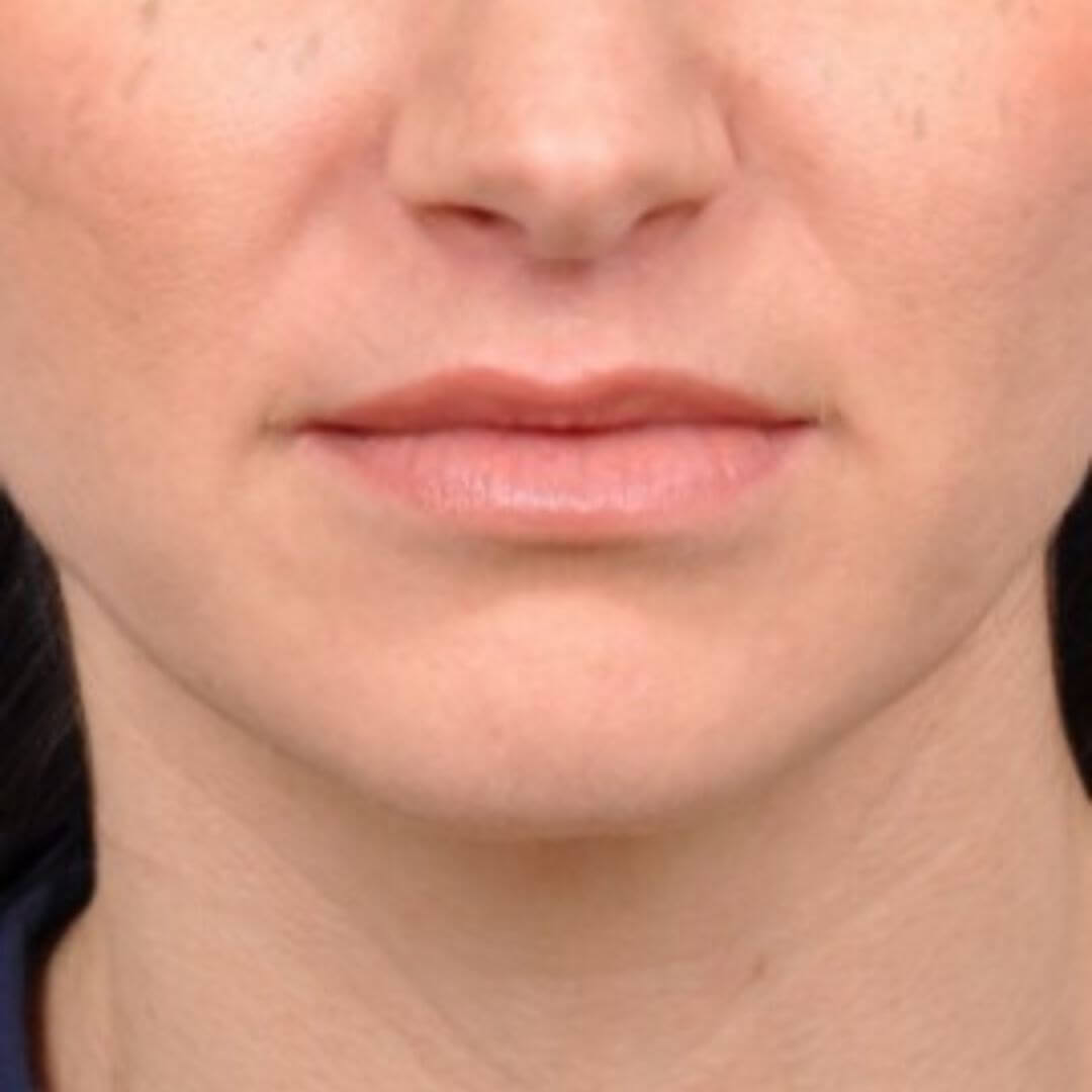 Gros plan des lèvres après la procédure de lip lift, révélant un volume et une définition améliorés de la lèvre supérieure.