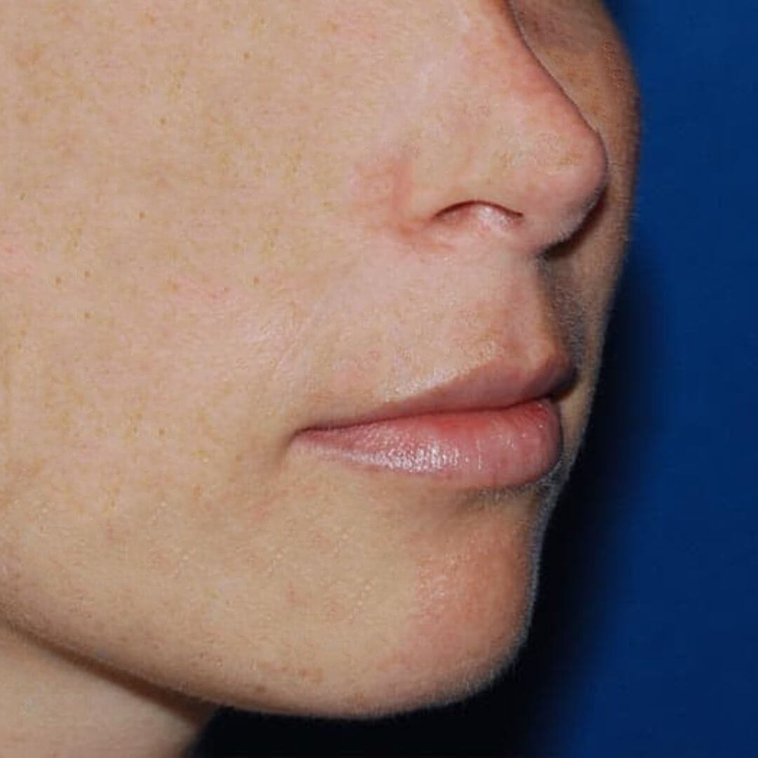 Photographie de profil du visage avant la chirurgie de lip lift, avec une expression faciale détendue.