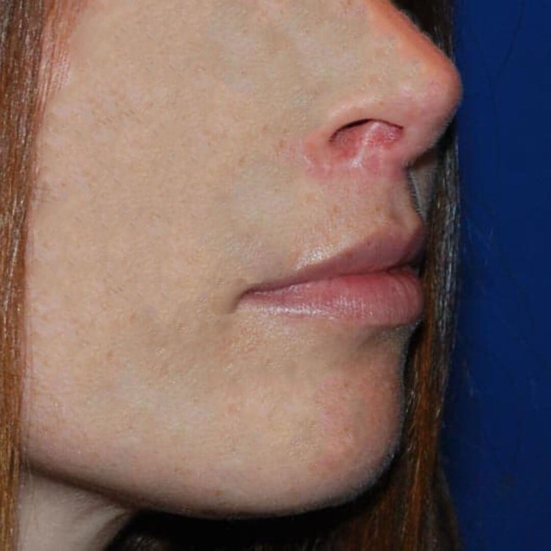 Vue de profil du visage après le lip lift