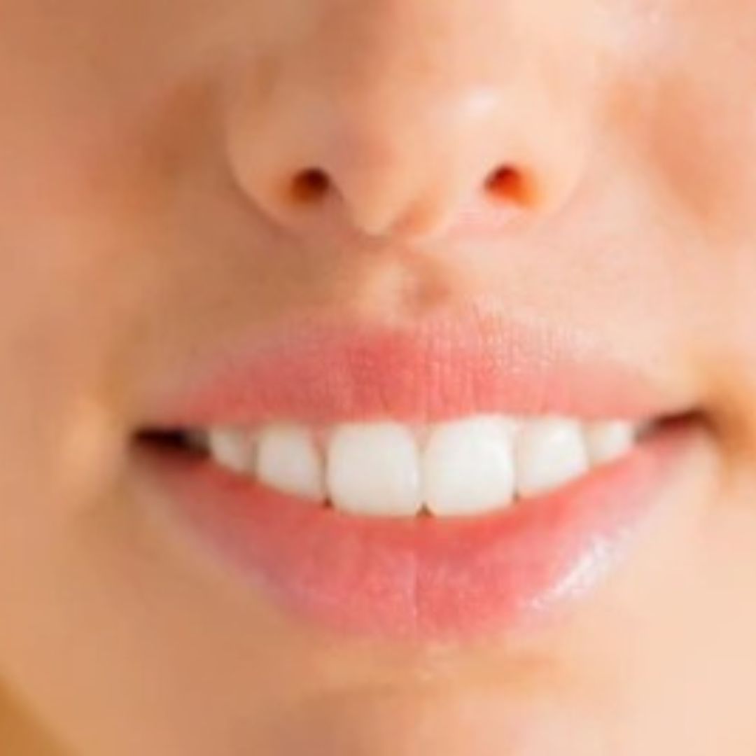 Image frontale du visage après la chirurgie de lip lift, avec un sourire radieux