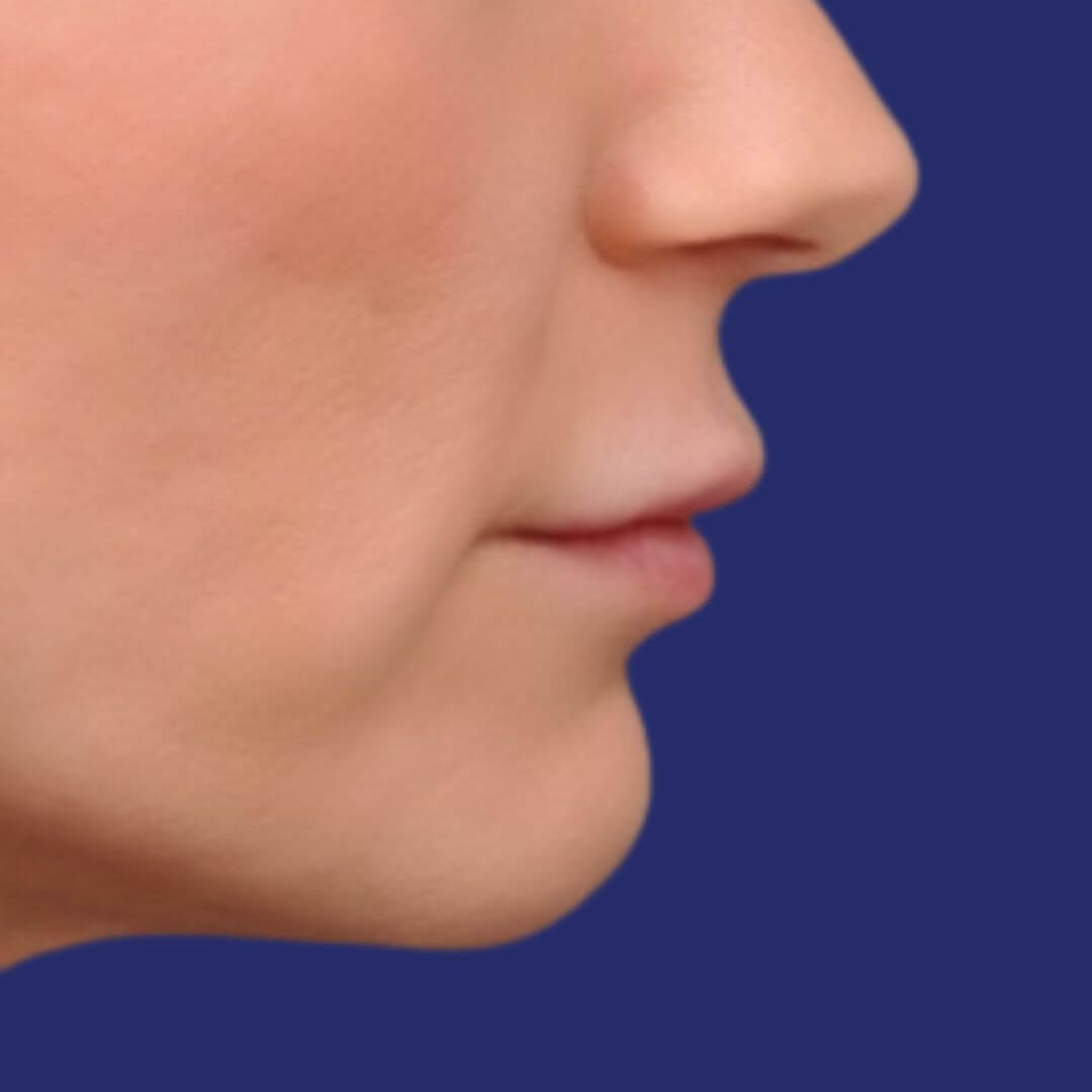 Close-up photo of lips with a gentle smile, highlighting the natural mouth shape before the lip lift.