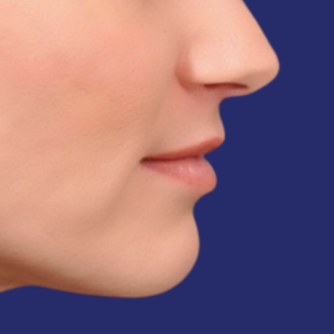 augmentation du volume et de la définition de la lèvre supérieure après le lip lift