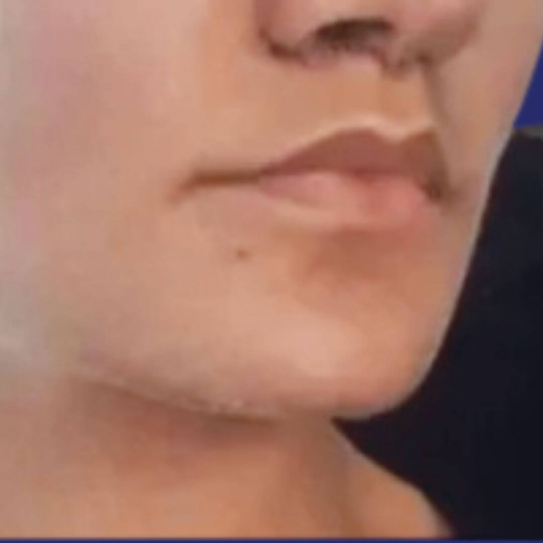Three-quarter view of the face after lip lift, showing improved facial harmony and more defined lips.