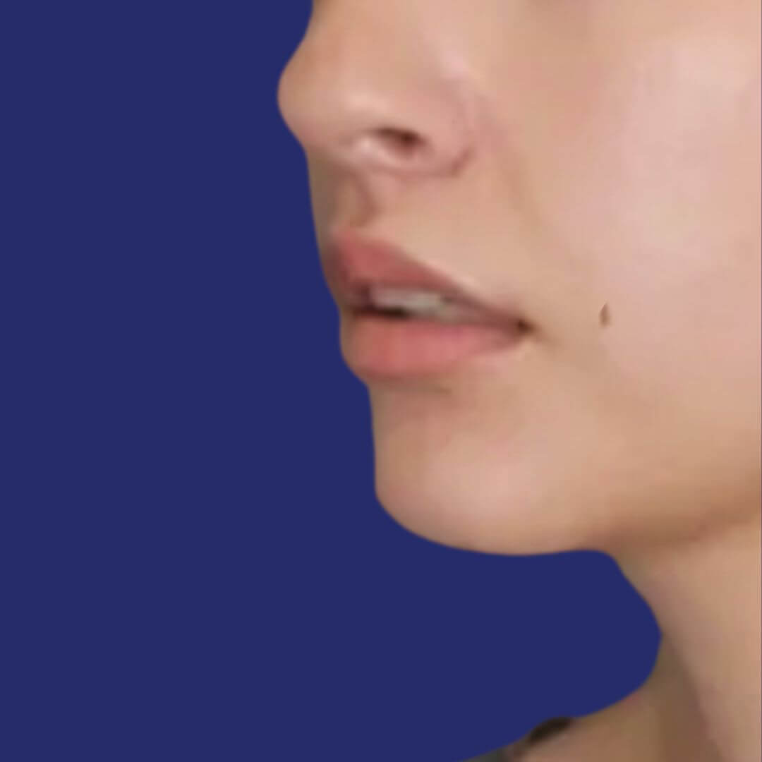 Gros plan des lèvres après le lip lift, révélant un volume accru et une définition améliorée de la lèvre supérieure.